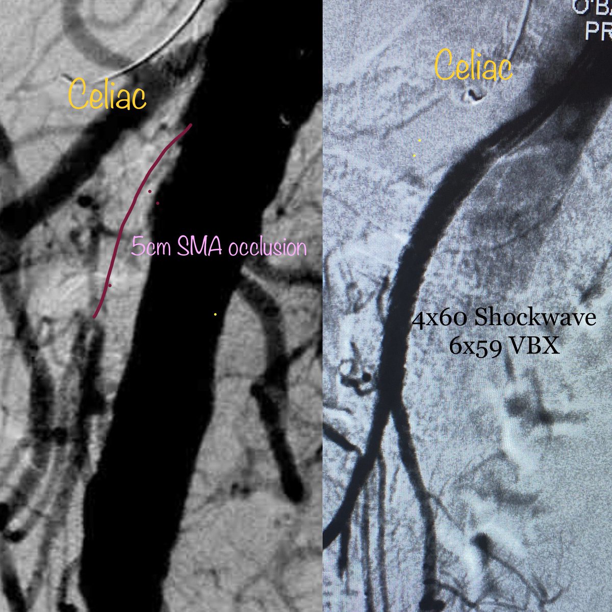 limbsalvagedr's tweet image. @ShockwaveIVL and @WLGore for the win! progressive small bowel ischemia despite patent celiac #ilost10yearsofmylifelastnight #crackthecalcium #vasctwitter
