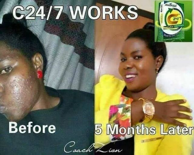 CoachEderlyn's tweet photo. ITS NOT ALL ABOUT MONEY, EVEN THE PRODUCTS WORK
#SkinDiseases
5 months back a friend of mine PROSKOVIA K from UGANDA her face got damaged because of using an expired jerry that she applied on her face but here is a testimony about the products of Alliance in motion global. https://t.co/39ifZnp3Wp