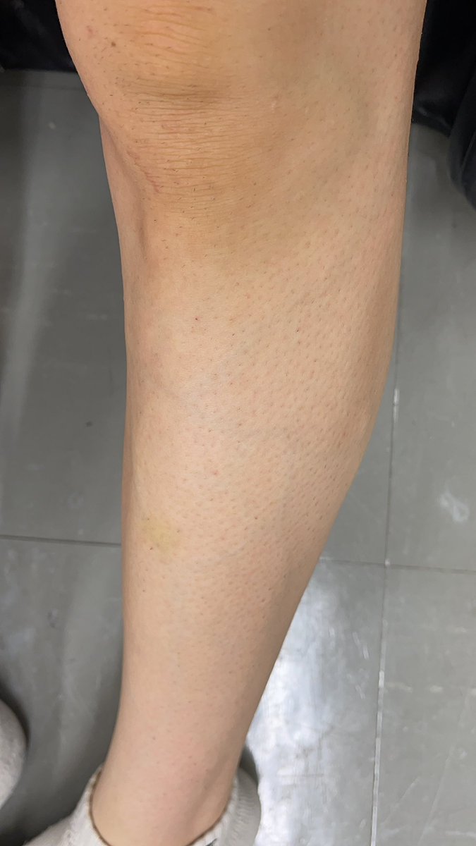 メンズ脱毛 歯列矯正 タッキーtv Logg Twitter