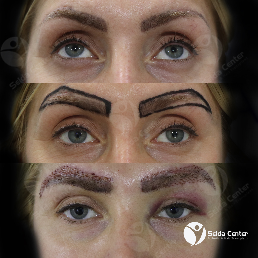 CenterSelda's tweet photo. Abbiamo coperto le cicatrice sulla soppraciglia che sono stati dagli altri interventi fatti del nostro paziente che venuta per il lavaggio dopo operazione.

🇮🇹+90 553 889 40 48⁠

#eyebrowtransplant #eyebrowtransplantturkey #capellisani #laperditadicapelli #salutare #innesti https://t.co/D5OxHbbOI2