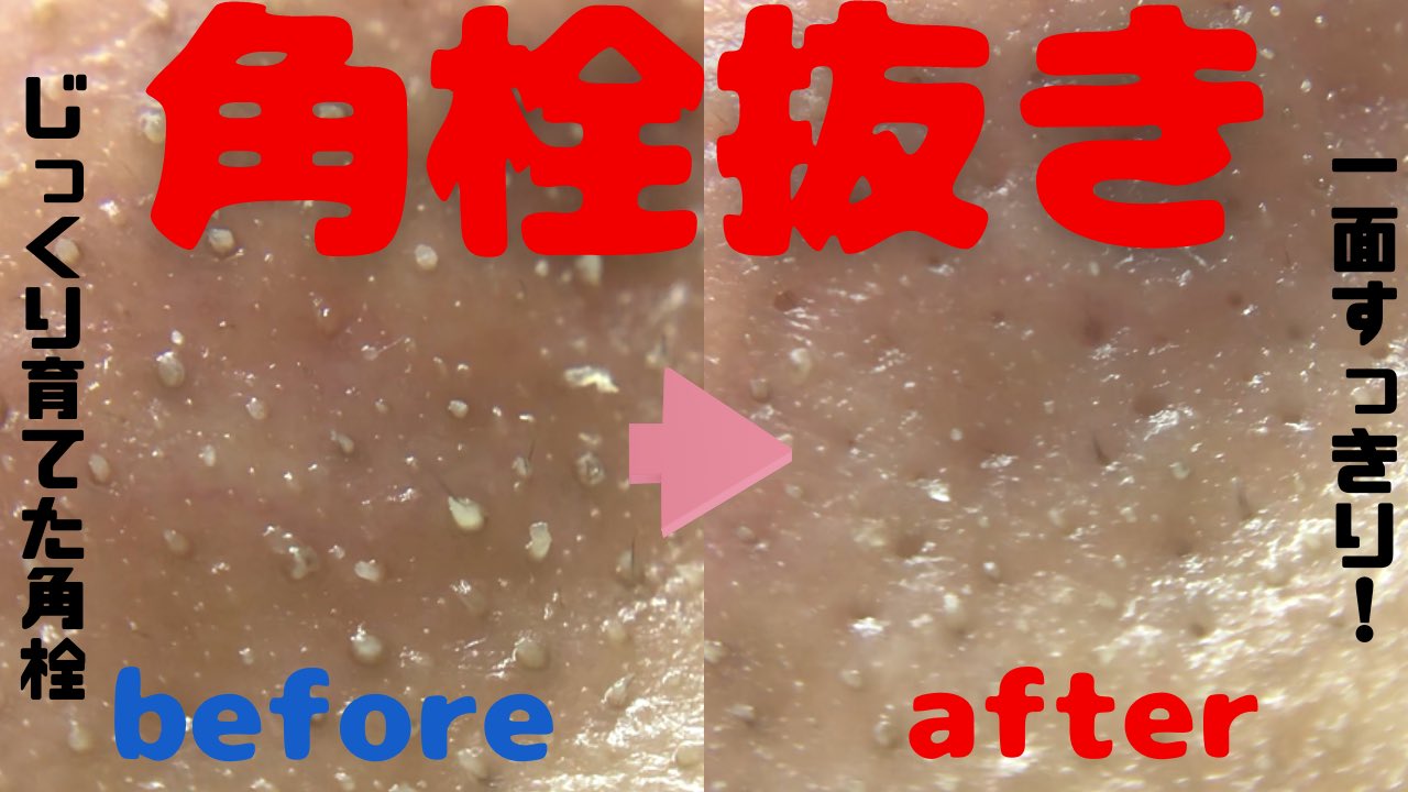 角栓マニア 角栓抜きyoutuber 角栓マニア 鼻の角栓一面をピンセットで抜いてみたビフォーアフターあり T Co Fkgazmbauy Youtubeより 角栓抜きオリンピック開催中 角栓抜き ピンセット 鼻の角栓 角栓除去 いちご鼻 Pimplepopping