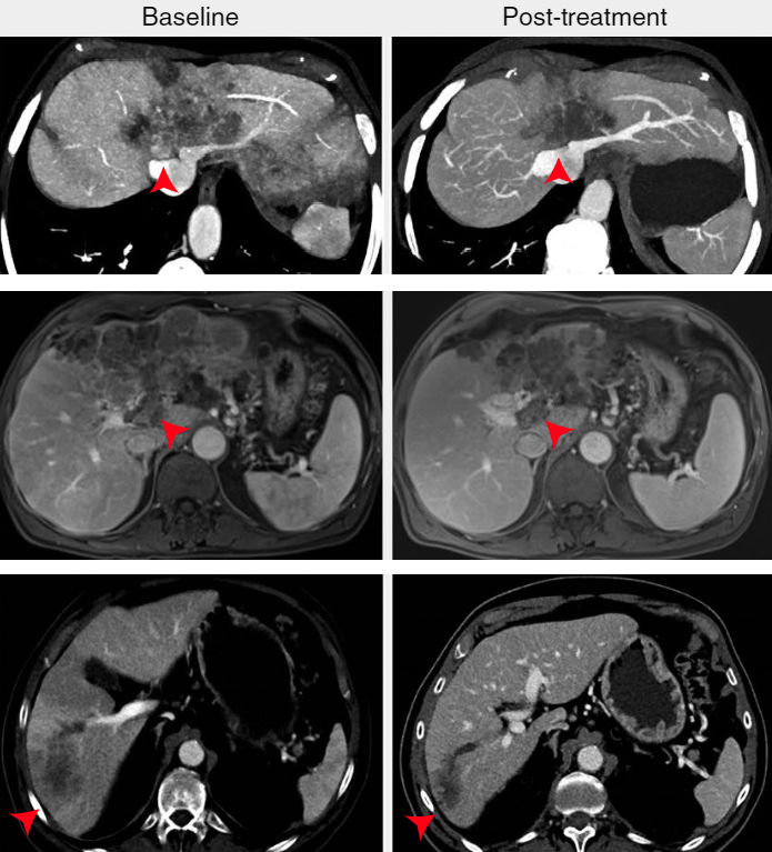 MarkYarchoan's tweet photo. Delighted to share our experience with neoadjuvant TKI+PD1 therapy in HCC beyond traditional resection criteria in Nature Cancer. https://t.co/7QpHK1c7WW. Cliff notes: https://t.co/zp8fD5eVpC