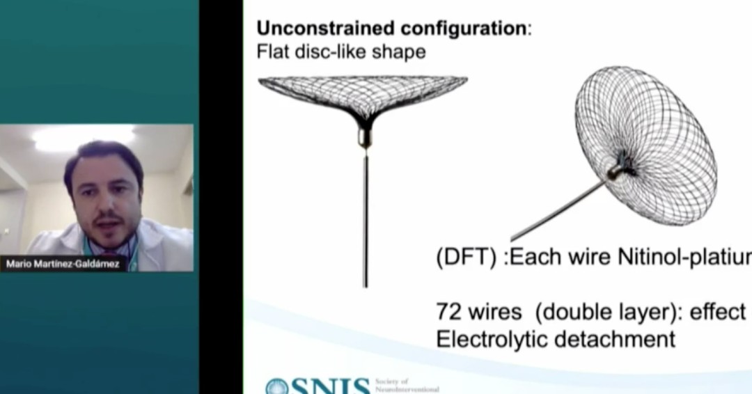 <a href="/DoctorGaldamez/">Mario Martínez-Galdámez</a> showing the latest in intrasaccular flow diversion: Contour Neurovascular System #SNIS2021 #NeuroIRTip
<a href="/GuenegoAdrien/">The French Brain Doctor</a> <a href="/lila_sheikhi/">Lila Sheikhi, MD</a> <a href="/DanniDiestro/">Dr. DiestroKE</a> <a href="/JNIS_BMJ/">JNIS</a> <a href="/esmintsociety/">ESMINT Society</a> 
<a href="/SNISinfo/">SNIS Info</a> <a href="/fcalbuquerque51/">Felipe C. Albuquerque</a> <a href="/aggiemarie93/">Marie Williams Denslow</a> <a href="/rdeleacymd/">Reade De Leacy MD</a> <a href="/Fie0815/">Jens Fiehler</a>