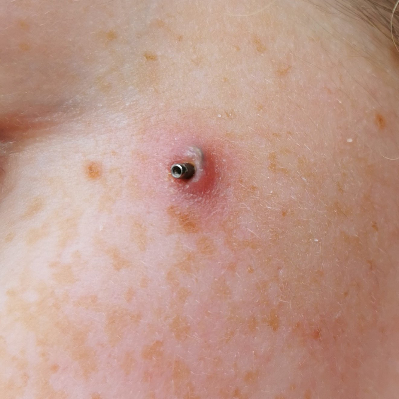 Dermal piercing rejecting store