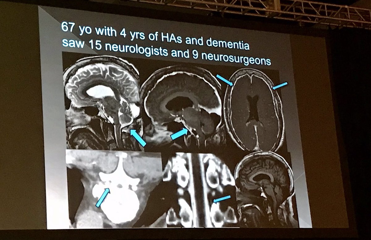 Sandra Narayanan, MD, FAHA, FANA, FSVIN, FAAN (@sandranarayanan) on Twitter photo #SNIS2021 <a href="/LindaGr4510/">linda gray</a> demonstrates meticulous diagnosis, technique & treatment of intracranial hypotension cases <a href="/SNISinfo/">SNIS Info</a> <a href="/cvsection/">CV Section</a> <a href="/TheASNR/">The American Society of Neuroradiology</a> <a href="/RadiologyACR/">American College of Radiology</a> @WBrinjikji <a href="/Fie0815/">Jens Fiehler</a> <a href="/esmintsociety/">ESMINT Society</a> <a href="/Michael3Abraham/">Michael Abraham</a> <a href="/DukeRadiology/">Duke Radiology</a> <a href="/JNIS_BMJ/">JNIS</a> <a href="/rdeleacymd/">Reade De Leacy MD</a> #SNIS2021 <a href="/LindaGr4510/">linda gray</a> demonstrates meticulous diagnosis, technique & treatment of intracranial hypotension cases <a href="/SNISinfo/">SNIS Info</a> <a href="/cvsection/">CV Section</a> <a href="/TheASNR/">The American Society of Neuroradiology</a> <a href="/RadiologyACR/">American College of Radiology</a> @WBrinjikji <a href="/Fie0815/">Jens Fiehler</a> <a href="/esmintsociety/">ESMINT Society</a> <a href="/Michael3Abraham/">Michael Abraham</a> <a href="/DukeRadiology/">Duke Radiology</a> <a href="/JNIS_BMJ/">JNIS</a> <a href="/rdeleacymd/">Reade De Leacy MD</a>