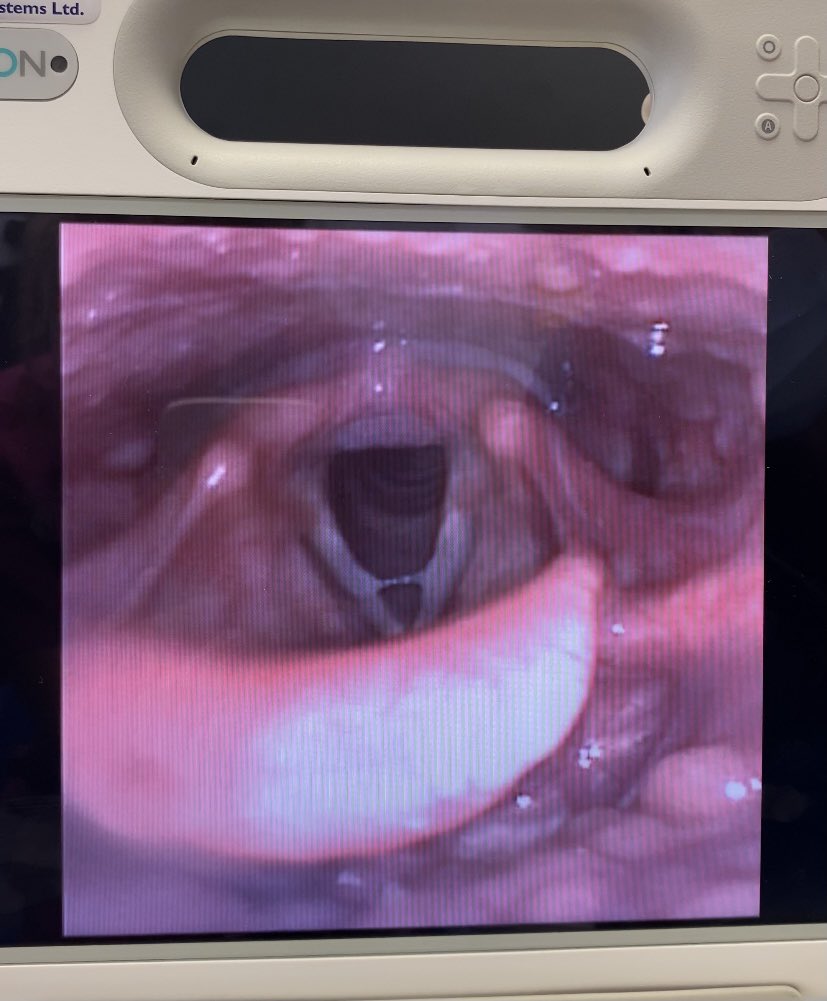 SuziCooksonSLT's tweet photo. Is it weird to post a picture of your larynx on Twitter? 🤷🏼‍♀️ Doing it anyway because this weeks placement highlight was getting a FEES done! Great opportunity to find out what we put our patients through as well as having the chance to examine my own anatomy! 🤓 https://t.co/kbP9aTmxsO