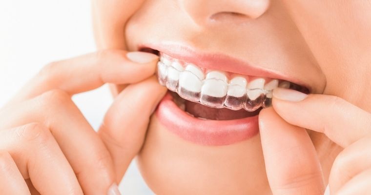 SchurOrtho's tweet photo. New post (Top 7 Questions About Invisalign Attachments Answered) has been published on Schur Orthodontics - https://t.co/i7w1RKiwJV https://t.co/vKwQdNeqke
