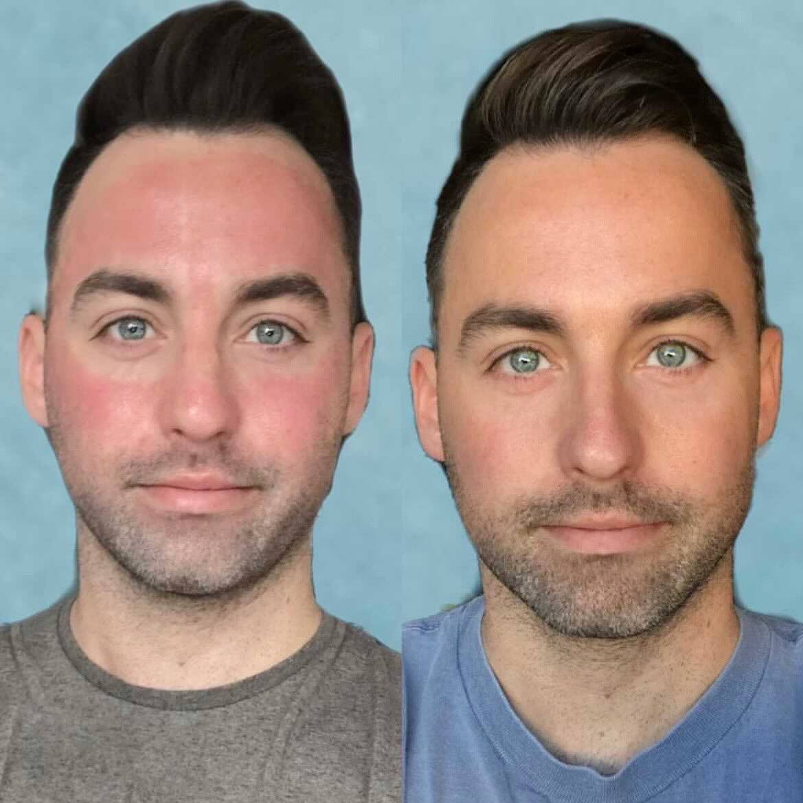 GLO30Facial's tweet photo. A before and after of the amazing @facesbybravo.

“Not an ad.  Just truly in love with this laser - the Clear &amp; Brilliant is extremely effective &amp; requires barely any downtime. Highly, highly recommend.”

➡️Head to https://t.co/dbS8ZKArQ8 to book your appointment today! https://t.co/wf5idokhZ5