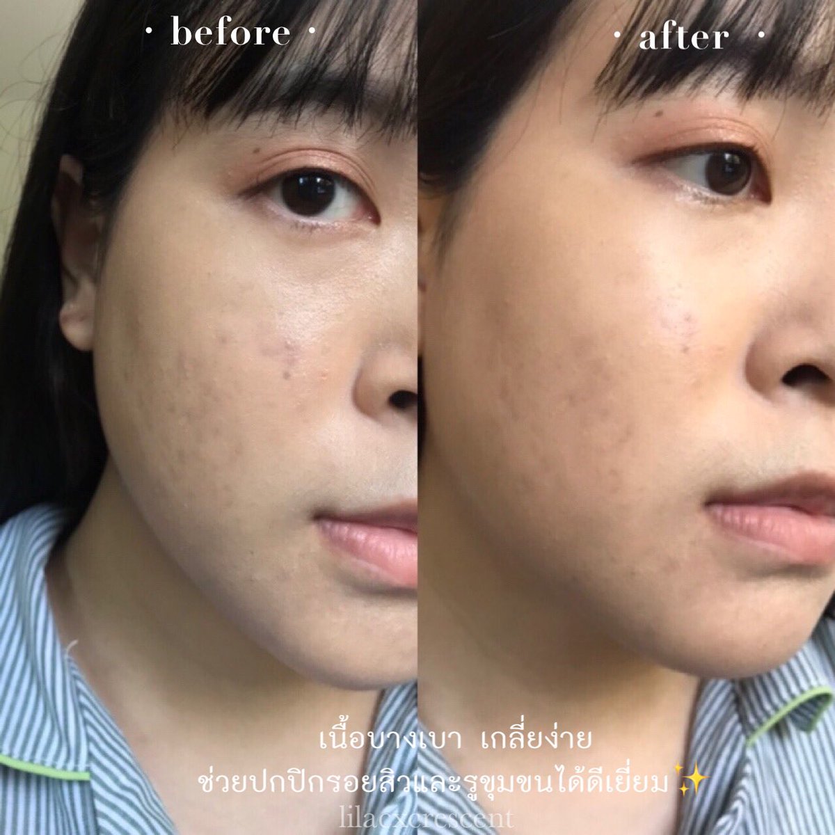 วันนี้จะออกไปข้างนอกก็ขอใช้แป้งฝุ่นคุมสิว BK Loose Powder 3D Diamond หน่อย💚 แป้งฝุ่นเซ็ตผิวบางเบา ส่วนผสมมาจากธรรมชาติสกัดจากใบบัวบก ช่วยลดการอักเสบจากสิว ไม่อุดตันสิว คุมมัน 12 ชั่วโมง ราคา 489 บาท ซื้อได้ที่ Konvy เลย💘
#BKDIAMOND #แป้งฝุ่นคุมสิว #แป้งฝุ่น #แป้งพัฟ #แป้งคุมสิว