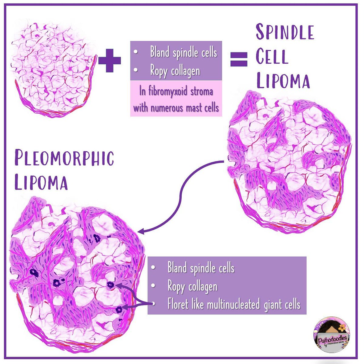 pathodoodles's tweet photo. Lipomas at a glance! #WHO2020 #BSTPath #PathTwitter #Pathboards #MedStudentTwitter #Pathodoodles https://t.co/rXuqALLlQ6