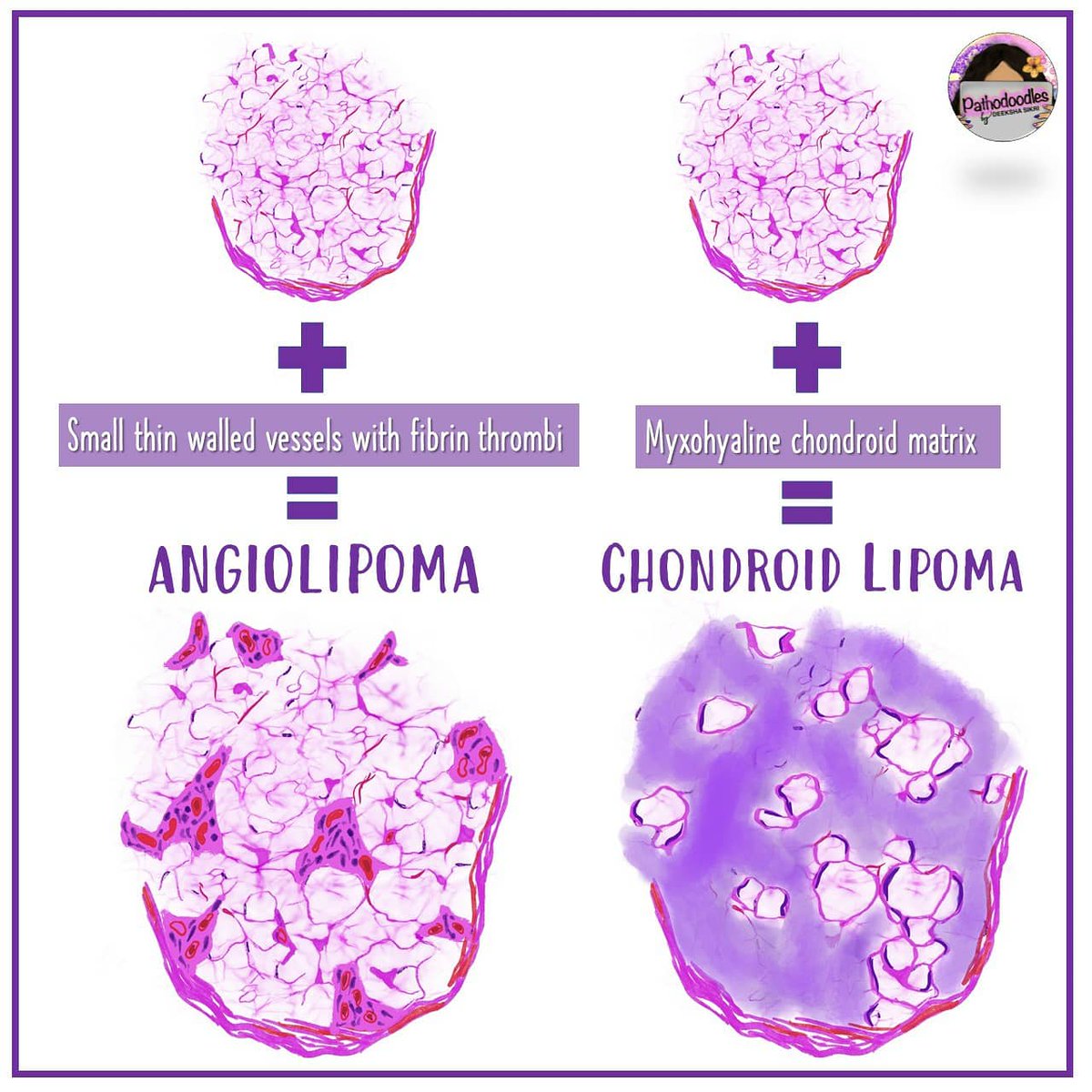 pathodoodles's tweet photo. Lipomas at a glance! #WHO2020 #BSTPath #PathTwitter #Pathboards #MedStudentTwitter #Pathodoodles https://t.co/rXuqALLlQ6