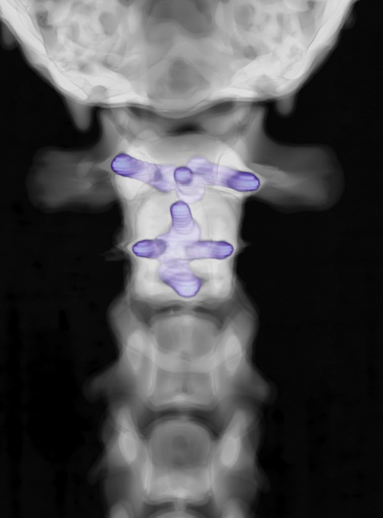 More perfect screw placements with the awesome <a href="/FusionImplants/">Fusion Implants</a> drilling guides.