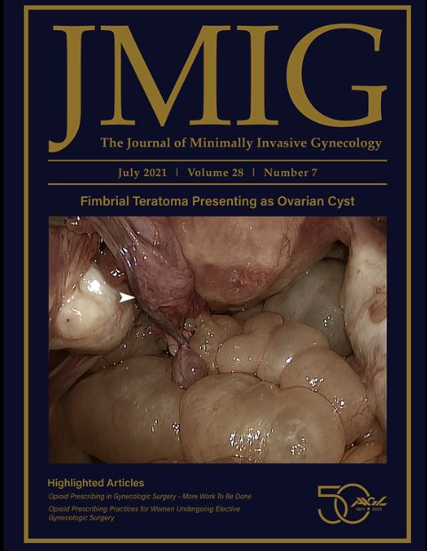 rickigottlieb's tweet image. In press! UAE as a tool to treat patients with anticoagulation associated abnormal uterine bleeding: “After UAE, 21 patients (88%) experienced substantial improvement or resolution of AUB and continued anticoagulation therapy.” @kapwatt @joeygolow @JacobCynamon