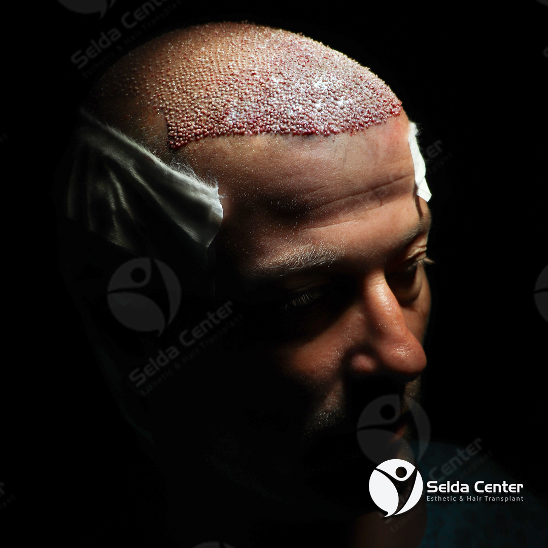 CenterSelda's tweet photo. ✨For an intense, dense and natural result, #FUEhairtransplantation!✨
✅#Densetransplantation was applied to the anterior regions of our dear patient.
✅We will follow the process together so that it has a permanent and natural appearance.

#hairtransplantation https://t.co/nQ1cManzm5