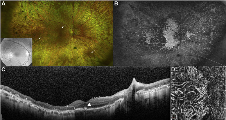 64 yo woman with biopsy-proven dense deposit disease since age of 24 years had undergone bilateral kidney transplantation sought treatment for central and peripheral drusen, bone-spicule pigmentation, and islands of outer retinal atrophy, mostly confluent. ow.ly/6jMo50FzDlN