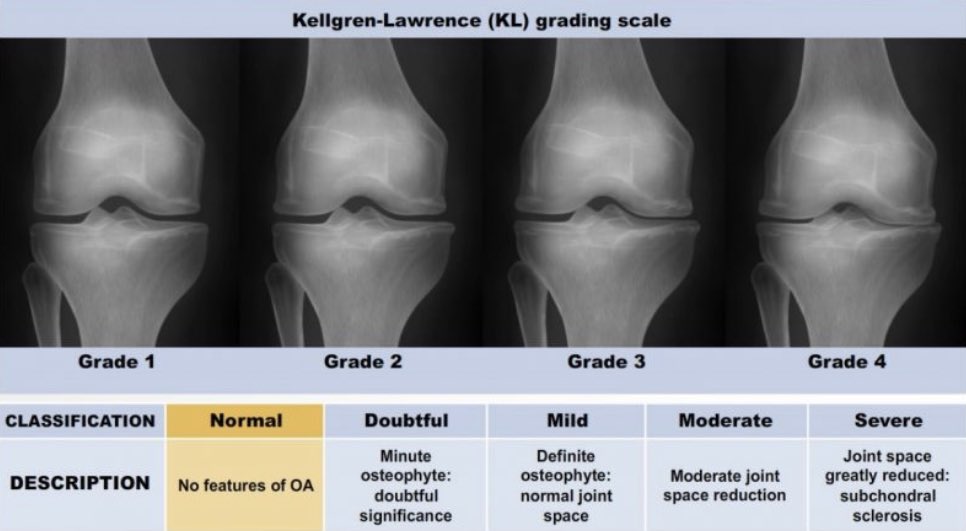 Check out the chart with the 4️⃣ stages of degenerative joint disease.