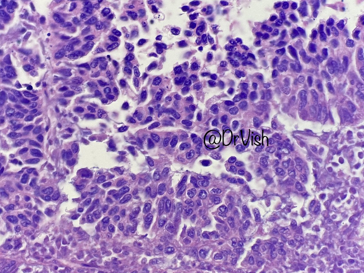 DrVish's tweet photo. Female in 50’s with axillary mass, pos AE1/AE3 and Cam5.2, neg mammoglobin, melanoma stains, ttf1, CK7/20 #PathTwitter #pathfiles #patheducation @Baskotacytopath @ac_pathgal @neuthunter @Florwrn @Dr_Brian_Cox @DrGeeONE @PAPatilMD @anjuthevirgo @EviAbadaMD @Meghna0630 https://t.co/Ok0rlNe6Zx