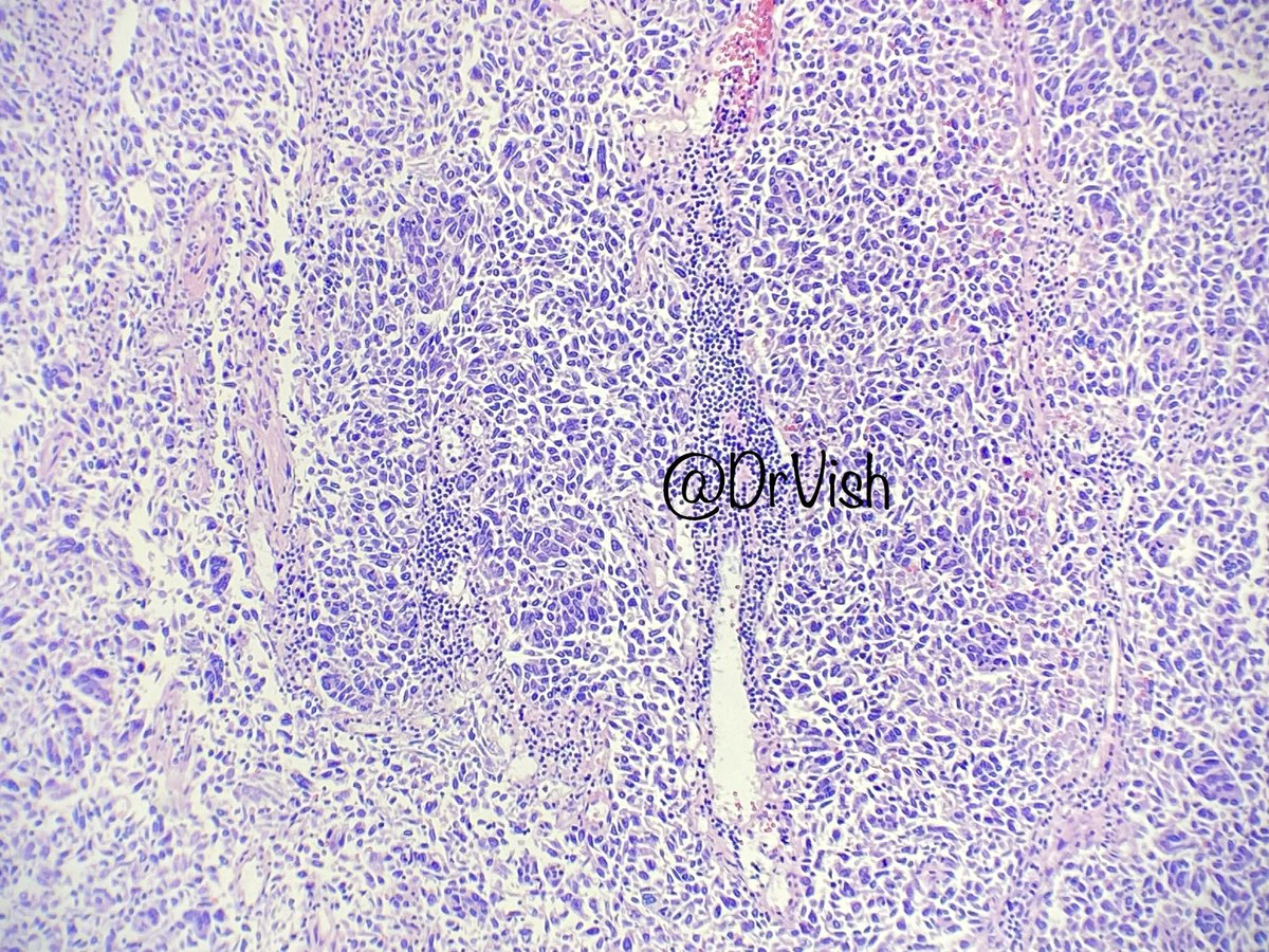 DrVish's tweet photo. Female in 50’s with axillary mass, pos AE1/AE3 and Cam5.2, neg mammoglobin, melanoma stains, ttf1, CK7/20 #PathTwitter #pathfiles #patheducation @Baskotacytopath @ac_pathgal @neuthunter @Florwrn @Dr_Brian_Cox @DrGeeONE @PAPatilMD @anjuthevirgo @EviAbadaMD @Meghna0630 https://t.co/Ok0rlNe6Zx