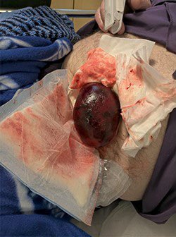 10bladeae's tweet photo. Time for some #FIOF! Swipe through for the CT  findings in this patient with an abnormally looking #colostomy post hartmann’s. What could be the cause? #figureitout on https://t.co/sCaHvyqLtR 

#SoMe4Surgery #SurgicalResident #Dubai 
#UAE #generalsurgery #imagechallenge https://t.co/PS6VEhmgsf