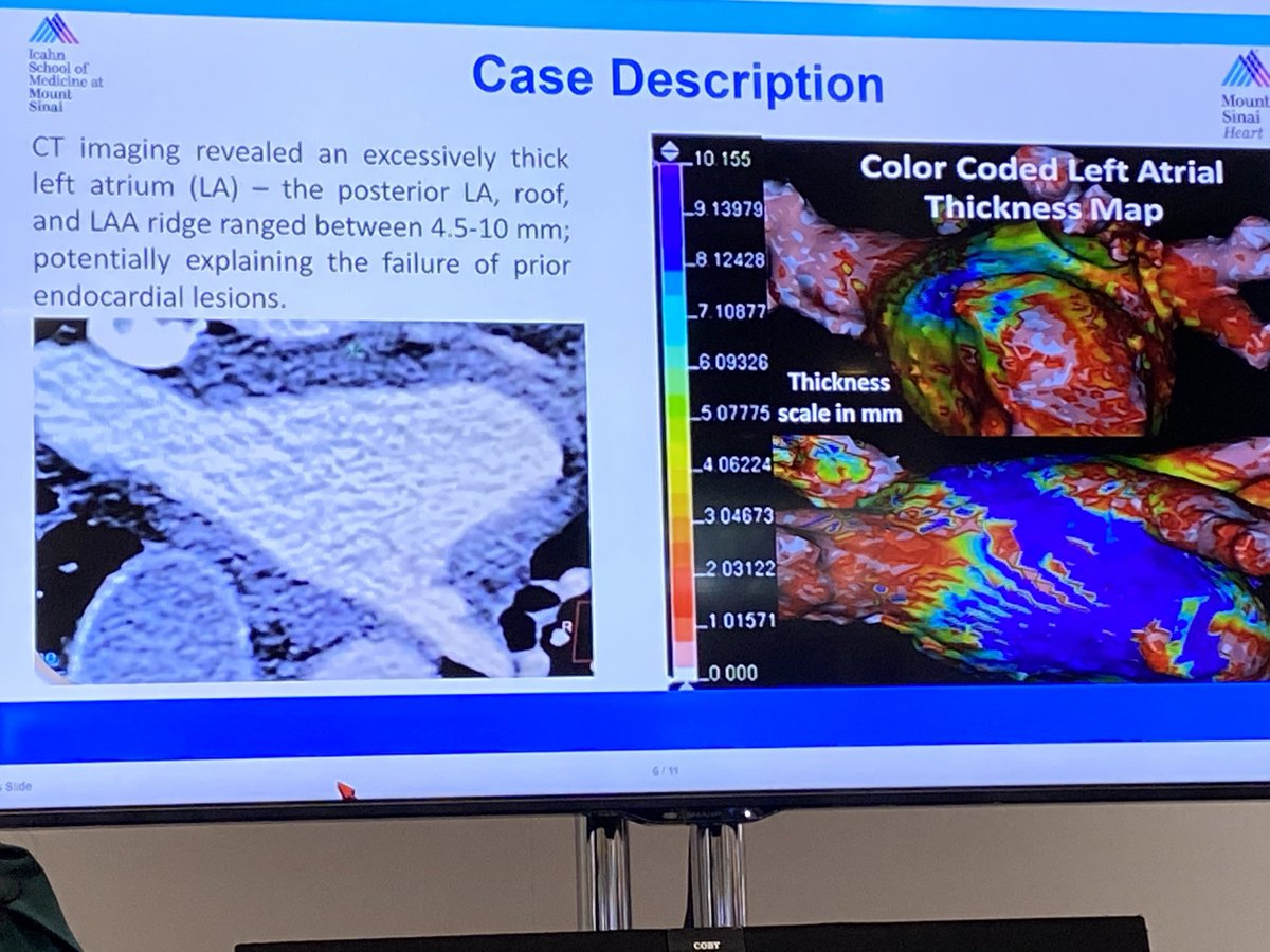 Jacob Koruth (@jskoruth) on Twitter photo <a href="/PoojitaShivamu1/">Poojita Shivamurthy</a> Very interesting case of diff AFL. Epicardial access for MI flutter. CT thickness segmentation tells us how thick the LA gets. And beware of SA nodal artery / GP during RF in this region <a href="/PoojitaShivamu1/">Poojita Shivamurthy</a> Very interesting case of diff AFL. Epicardial access for MI flutter. CT thickness segmentation tells us how thick the LA gets. And beware of SA nodal artery / GP during RF in this region