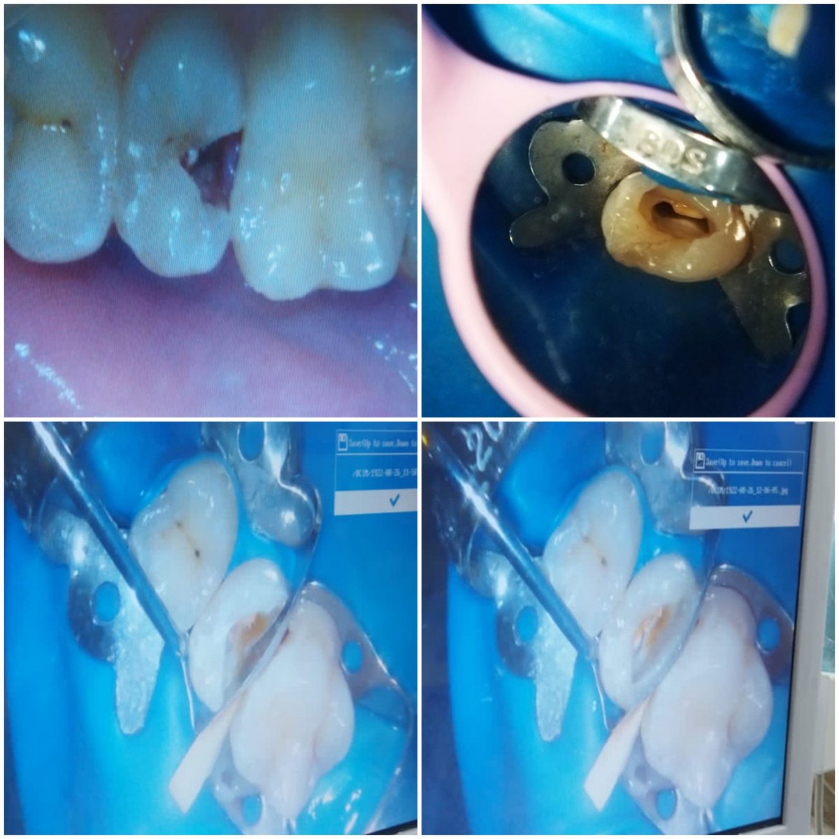 EslamSharsheer's tweet photo. Single visit from Endo to resto 😍😍
#Deep_margin_elevation
#gingivectomy
#جمعتكم__مباركة https://t.co/A65r6x9x8R