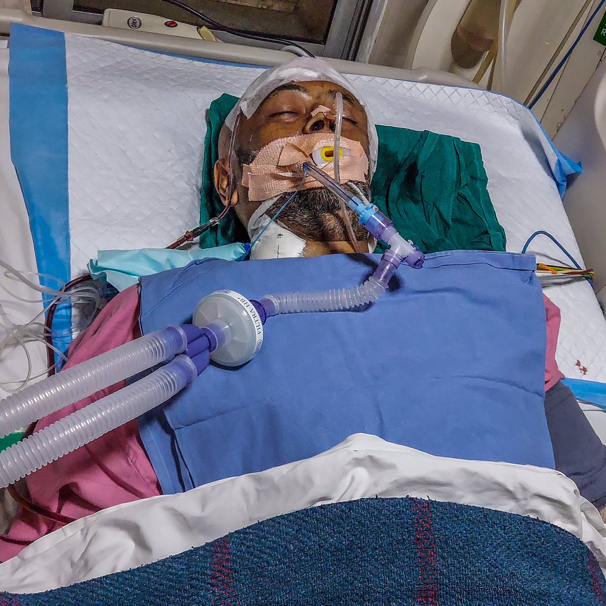 𝐔𝐑𝐆𝐄𝐍𝐓: “My husband suffered a paralytic stroke caused by a brain clot &amp; is admitted to the ICU. It breaks our hearts to see him suffer, but unfortunately his medical expenses are beyond our financial means. Please help.”

To Support: bit.ly/Save_Anand