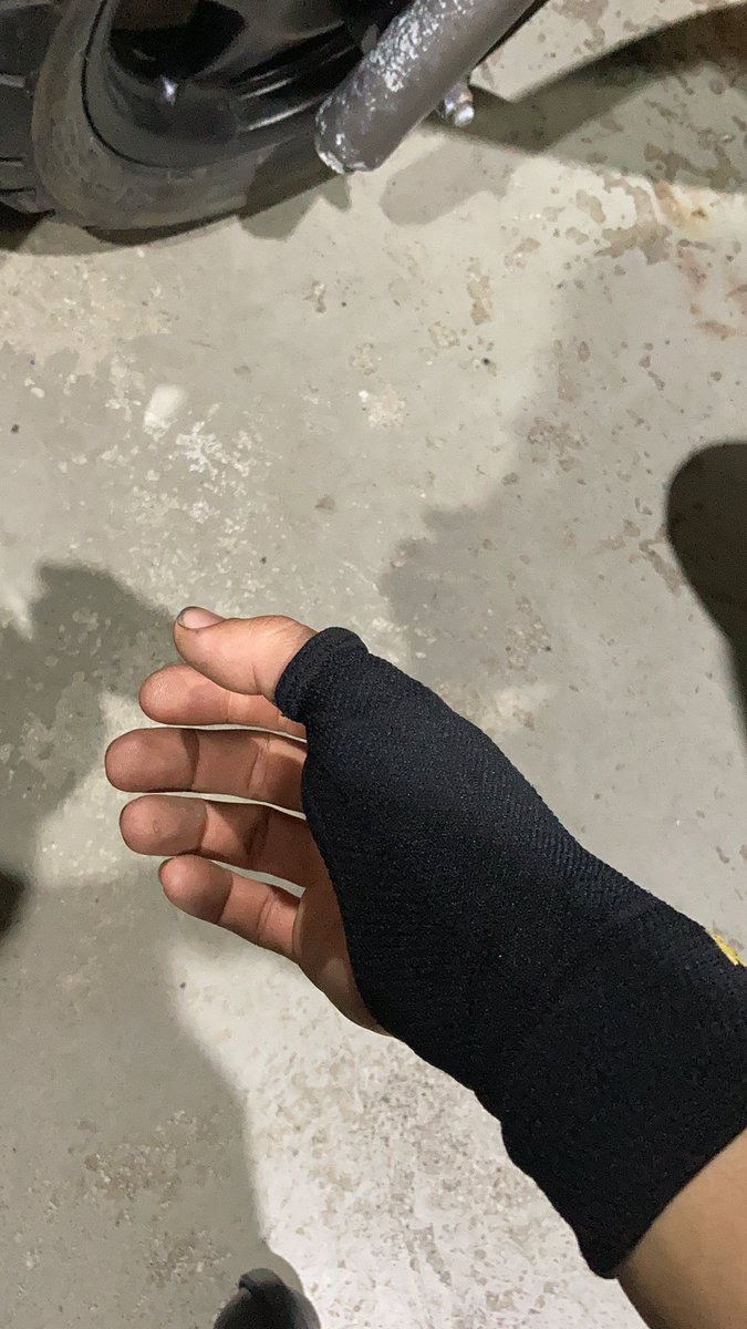 Billykundarts's tweet photo. ダーツから離れてたけど
またダーツが楽しくなってきた矢先
負傷🥲
腱鞘炎じゃないけど、付け根の関節か何かがイテー
お箸使えないぐらいイテー https://t.co/7G78TTnfCe