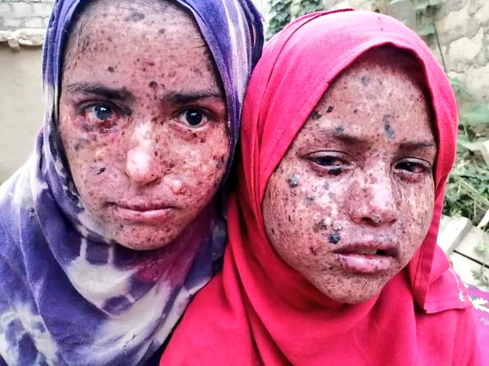 RehanZeb21's tweet photo. Appeal! Four daughters of a poor labor in Salarzai Chinar district Bajaur, suffering from a serious skin disease, are waiting for your help. These girls want to study in school and madrasa but cannot go out of the house due to this disease and discomfort. hers poor father ..2/1 https://t.co/htPmHYxeih