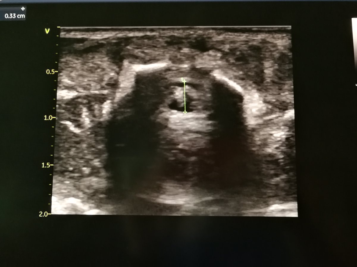 fracardo's tweet photo. Read the paper https://t.co/EUVwYEIBv7 - decided to use ultrasound on next LP - success! #1000g #ultrasoundguided #lumbarpuncture #applyingresearch #neotwitter https://t.co/pfYrUWjQXa