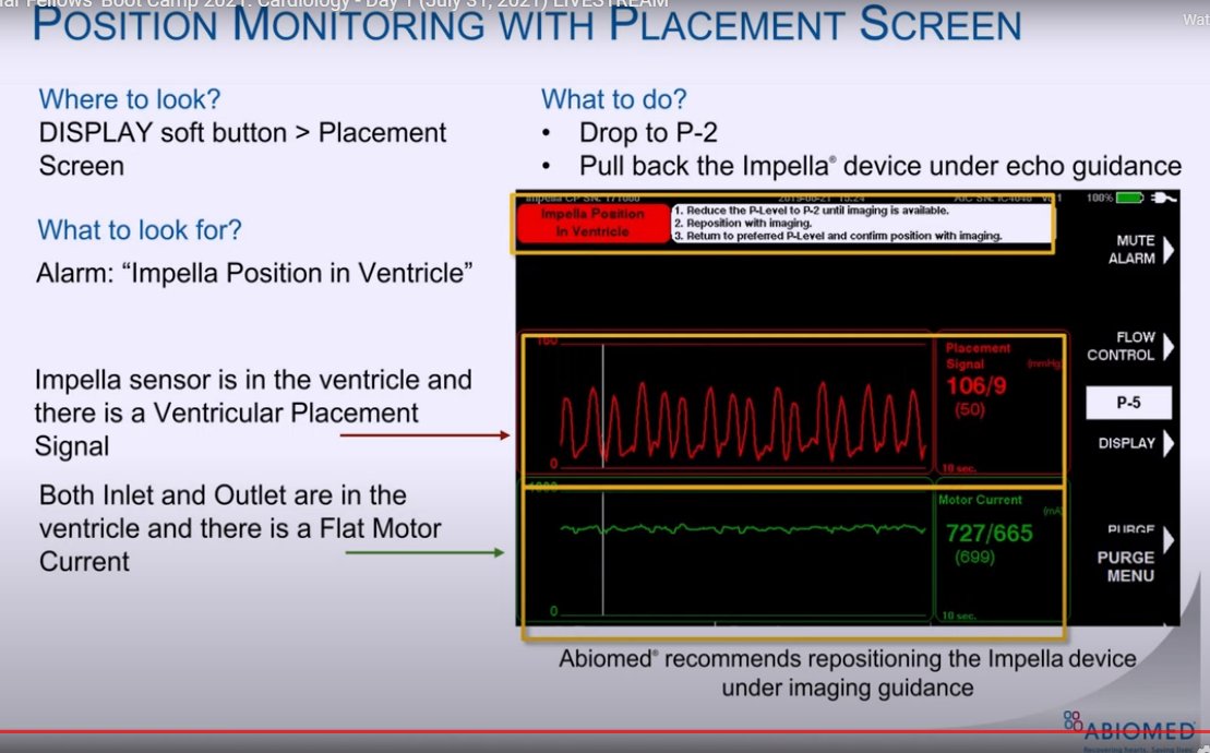 HJRyooAli's tweet image. Pure 🦪for first year fellows from @IceTeaMD re: temporary MCS!

✔️placement of IABP Impella!
➡️Top right: waveforms when Impella is in aorta, push Impella in.
⬅️Bottom left: waveforms when Impella is in LV, pull Impella out.
💡How to reposition w TTE guidance. 
#CVBootCamp2021