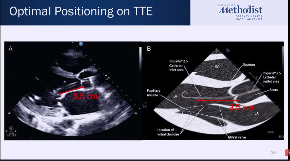 HJRyooAli's tweet image. Pure 🦪for first year fellows from @IceTeaMD re: temporary MCS!

✔️placement of IABP Impella!
➡️Top right: waveforms when Impella is in aorta, push Impella in.
⬅️Bottom left: waveforms when Impella is in LV, pull Impella out.
💡How to reposition w TTE guidance. 
#CVBootCamp2021