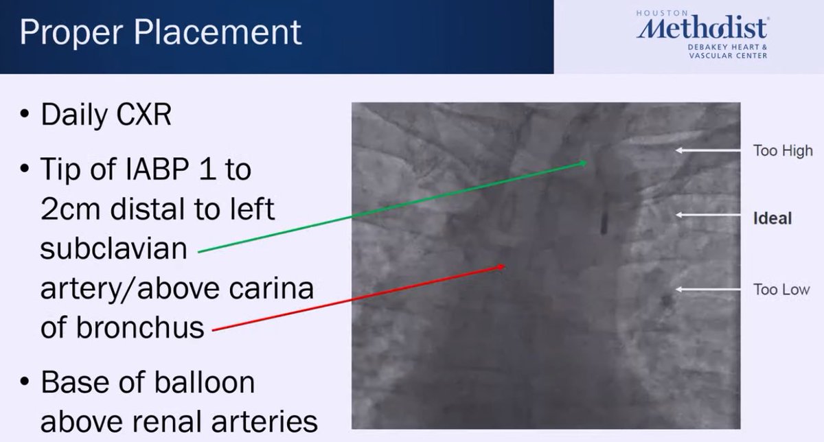 HJRyooAli's tweet image. Pure 🦪for first year fellows from @IceTeaMD re: temporary MCS!

✔️placement of IABP Impella!
➡️Top right: waveforms when Impella is in aorta, push Impella in.
⬅️Bottom left: waveforms when Impella is in LV, pull Impella out.
💡How to reposition w TTE guidance. 
#CVBootCamp2021