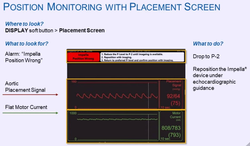 HJRyooAli's tweet image. Pure 🦪for first year fellows from @IceTeaMD re: temporary MCS!

✔️placement of IABP Impella!
➡️Top right: waveforms when Impella is in aorta, push Impella in.
⬅️Bottom left: waveforms when Impella is in LV, pull Impella out.
💡How to reposition w TTE guidance. 
#CVBootCamp2021