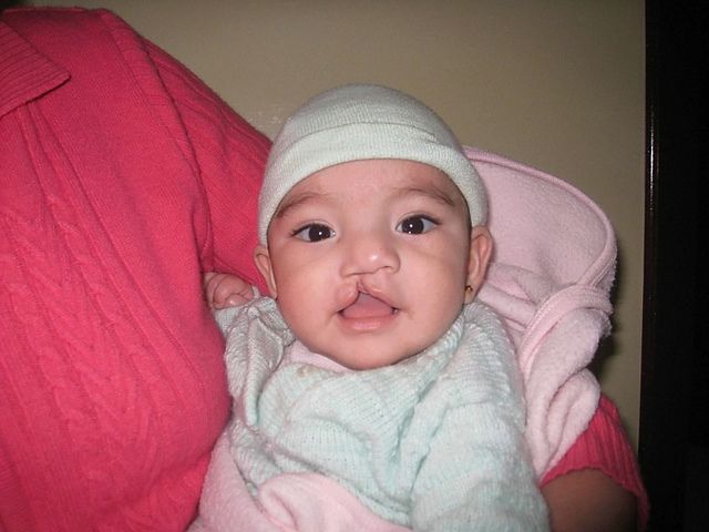ReSurge's tweet photo. Today is the last day of #CleftAwarenessMonth. It only take a donation of $350 to cover all the costs of a cleft repair. A small price to change a life. Will you help?
https://t.co/APfbQiXzYz
#MakeaDifference
#GlobalSurgery
#SurgeryNotStigma https://t.co/74g5eontXJ