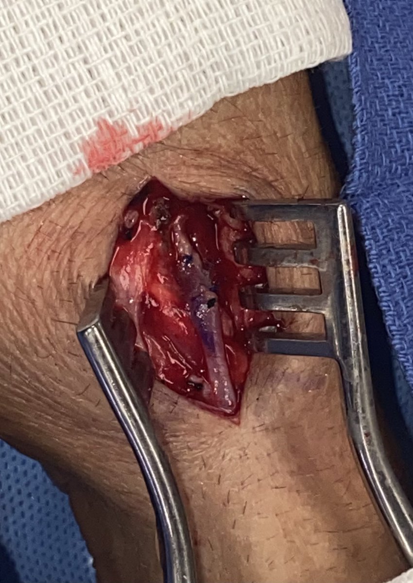 Vernon_HorstMD's tweet photo. 40s y/o patient with ESRD on HD. Left hand dominant. Pre-op mapping w anatomy consistent with Cimino creation. Post-block I couldn’t help but notice the snuffbox opportunity. 4.5 weeks post-op, flow volume >400mL/min. #useit #vascularaccess #lifeaccessplan #vascularsurgeon https://t.co/9U0H2mJi7t