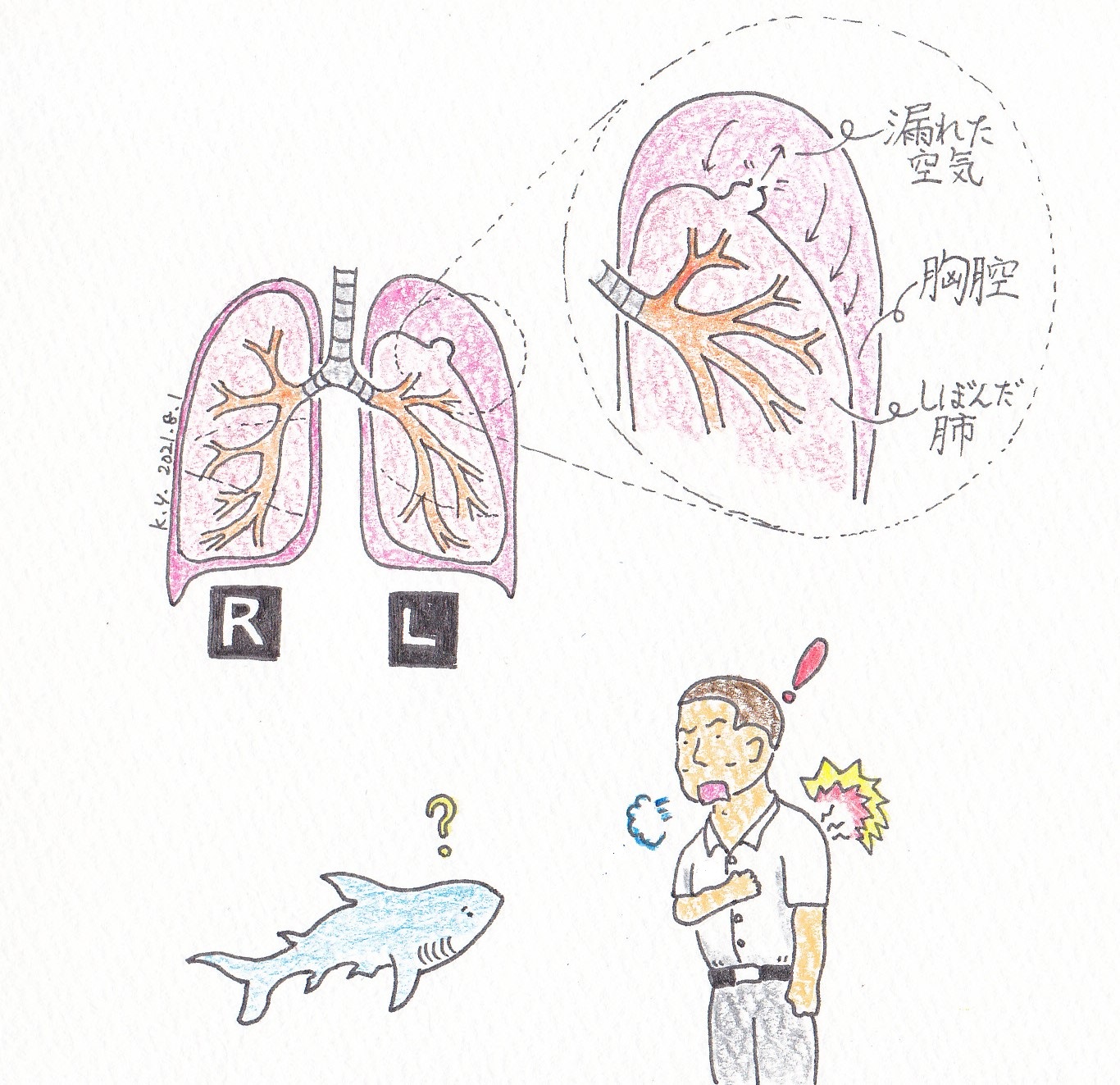 ゆりこうだい 1 肺 81 の日 気胸に注意 気胸 肺のパンク 肺の一部が破れ 漏れた空気が肺を圧迫 肩こりや神経痛のような胸痛 呼吸苦 漏気音を感じたら病院へ 一日一絵 イラスト 肺 肺の日 気胸 自然気胸 Pneumothorax T ゆりこうだい 1 肺 81 の日 気胸に注意 気胸 肺のパンク 肺の一部が破れ 漏れた空気が肺を圧迫 肩こりや神経痛のような胸痛 呼吸苦 漏気音を感じたら病院へ 一日一絵 イラスト 肺 肺の日 気胸 自然気胸 Pneumothorax T
