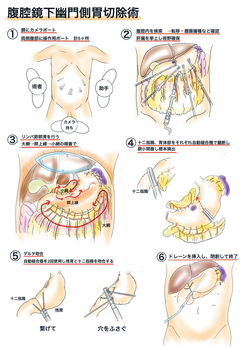 文字なしver. 腹腔鏡下幽門側胃切除術の概要