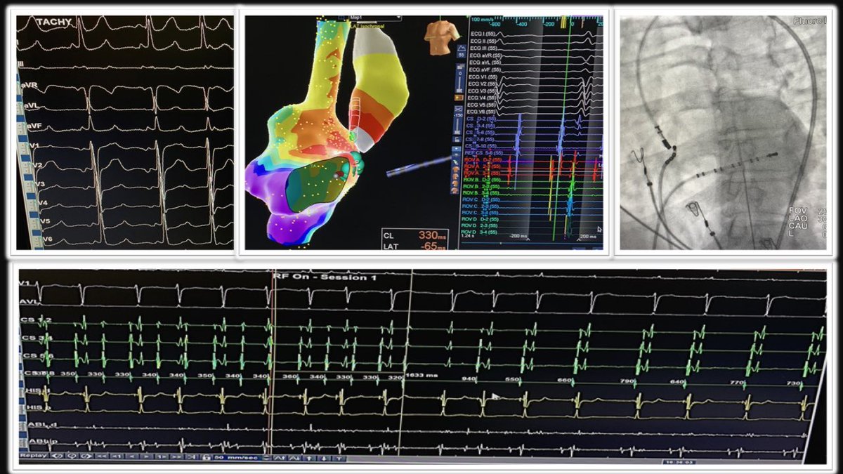 Dr.Jayapandian P (@jayapan59971280) on Twitter photo A case of incessant Atrial Tachy, RA mapped with HDGrid,shows a focal pattern with 65ms earlier at at HIS,,<a href="/NCC/">National Community Church</a> same 65ms early from onset of P,QS in unipolarā¦Coolflex irrgn lession(30w,43c).Achieved termination in 1.6sec and no more induciblity ā¦. A case of incessant Atrial Tachy, RA mapped with HDGrid,shows a focal pattern with 65ms earlier at at HIS,,<a href="/NCC/">National Community Church</a> same 65ms early from onset of P,QS in unipolarā¦Coolflex irrgn lession(30w,43c).Achieved termination in 1.6sec and no more induciblity ā¦.