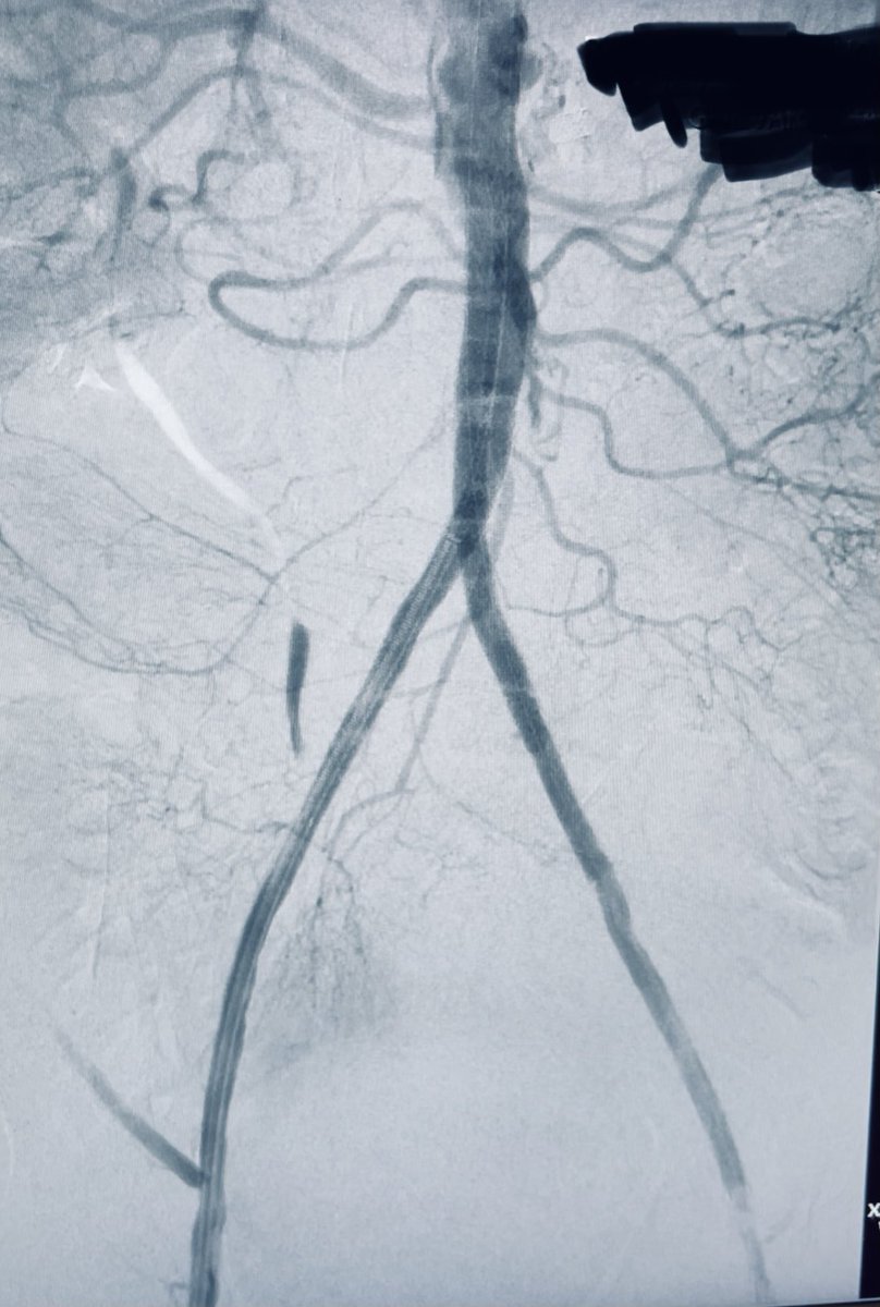Carlos Guevara MD, FSIR (@carlosguevarair) on Twitter photo Pictures are worth a thousand words. CTO of infrarenal aorta to EIA @Saukalaka <a href="/ZagumBhatti/">Zagum Bhatti MD</a> <a href="/kmadass/">Kumar Madassery</a> <a href="/Sushinsk/">Sasha Ushinsky</a> <a href="/SDhandMD/">Sabeen Dhand</a> <a href="/saherssabri/">Saher Sabri</a> <a href="/cathycarneyir/">Catherine Carney</a> <a href="/JVIRmedia/">JVIR</a> <a href="/SIRspecialists/">Society of Interventional Radiology</a> <a href="/WashUIR/">Mallinckrodt IR</a> <a href="/LechKiki/">KikiLech</a> Pictures are worth a thousand words. CTO of infrarenal aorta to EIA @Saukalaka <a href="/ZagumBhatti/">Zagum Bhatti MD</a> <a href="/kmadass/">Kumar Madassery</a> <a href="/Sushinsk/">Sasha Ushinsky</a> <a href="/SDhandMD/">Sabeen Dhand</a> <a href="/saherssabri/">Saher Sabri</a> <a href="/cathycarneyir/">Catherine Carney</a> <a href="/JVIRmedia/">JVIR</a> <a href="/SIRspecialists/">Society of Interventional Radiology</a> <a href="/WashUIR/">Mallinckrodt IR</a> <a href="/LechKiki/">KikiLech</a>