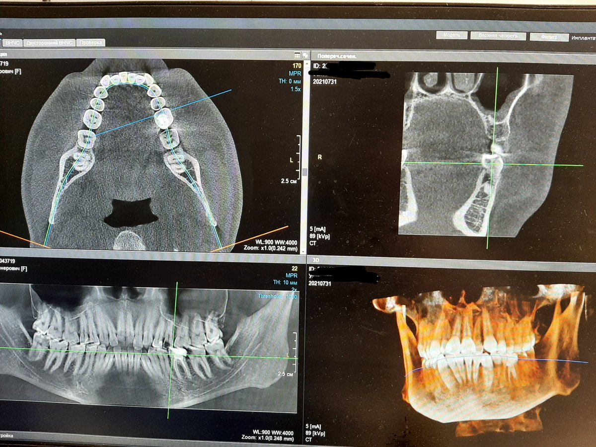 I made a computed tomography of the jaws.  The idea came to draw a 3D model out of it.  Here's what happened. Do you have any idea what you can do about it?
#fastjt #nftart