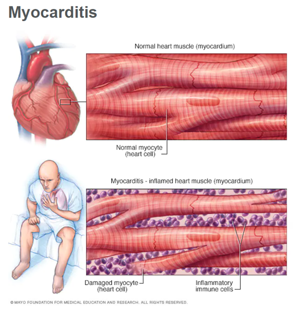 myocardite