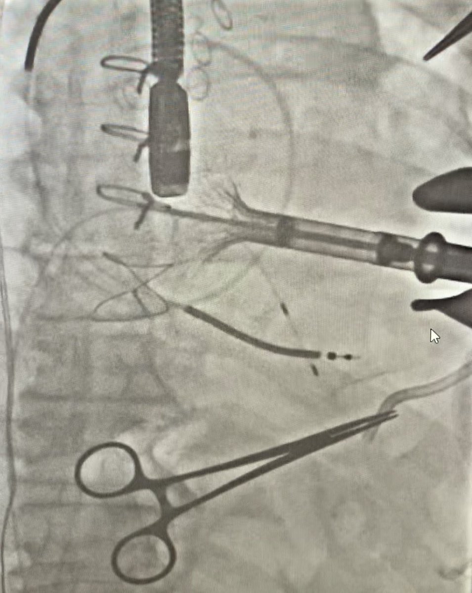 sabeedak1's tweet photo. It’s been a fun July @vumcvalve @colinbarkerMD @kashishgoelmd @JaredOLeary @HollyGHeartMed #tavr #mitraclip #TMViV #TAViV #MVplug #triclip #PFO #Coarctation #cardiotwitter
@Melissa_C_Long the #TMVR https://t.co/pmmUcLOZSq
