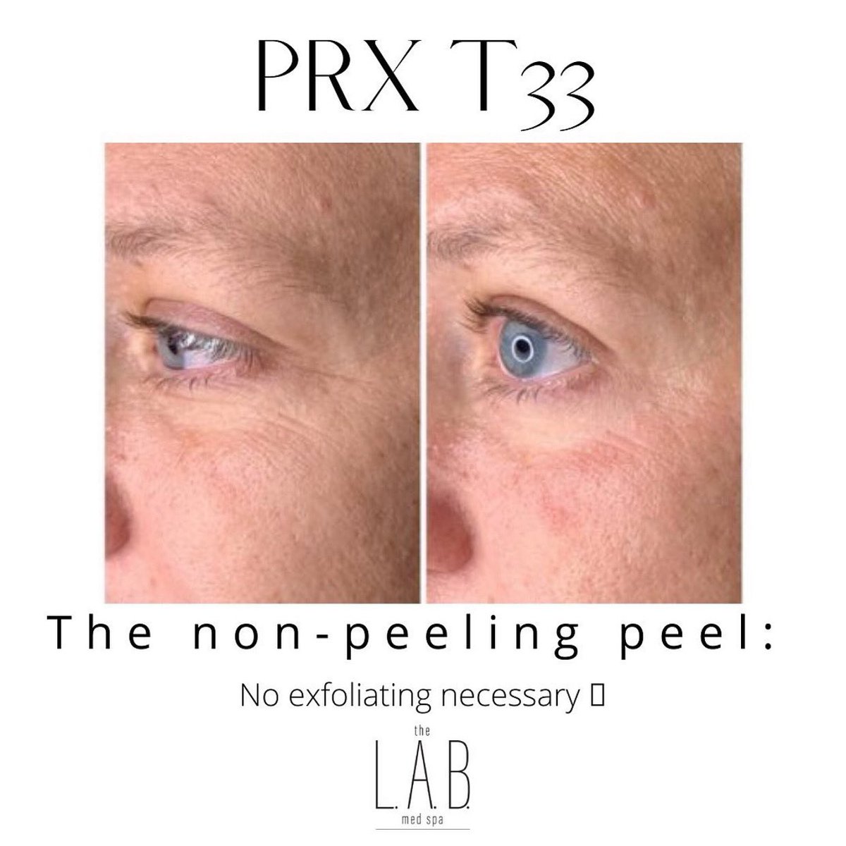 thelabmedspa's tweet photo. Benefits of PRX-T33
* Improve skin hydration.
* Reduce the appearance of scars (acne and other)
* Minimize the appearance of pores.
* Lift sagging skin.
* Brighten dull skin.
#skin #peel #medspa #prxt33 #beauty #dfw #southlakemoms #kellermoms #texas #noexfoliation https://t.co/TWm2DNDzuD