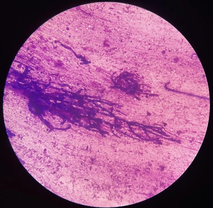 Prernaw2's tweet image. 65yr old diabetic Male, soft tissue swelling over left ankle for 3-4 years, FNAC done #twitterpath #cytology #pathology #infectiousdisease #branchingfungalhyphae #twitterpathology #softtissue #BST #BSTpath