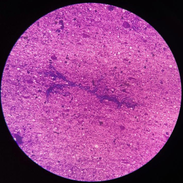 Prernaw2's tweet image. 65yr old diabetic Male, soft tissue swelling over left ankle for 3-4 years, FNAC done #twitterpath #cytology #pathology #infectiousdisease #branchingfungalhyphae #twitterpathology #softtissue #BST #BSTpath