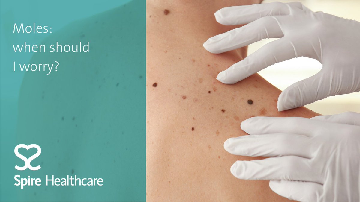 SpireWorcester's tweet photo. Most of the time, moles are harmless. However, they can sometimes develop into cancer. So, a new mole, or one that changes in appearance should be checked out.

Here’s everything you need to know: https://t.co/in9Bg6GFK0
#healthcare #skincancerawareness https://t.co/cDPblG8xdz
