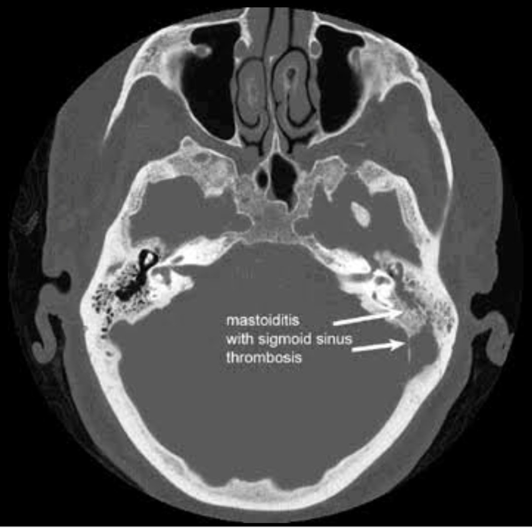 Утолщение слизистой сосцевидного отростка. Мастоидит на кт височных костей. Тромбоз сигмовидного синуса на кт. Мастоидит височной кости кт. Сигмовидный синус височной кости кт.