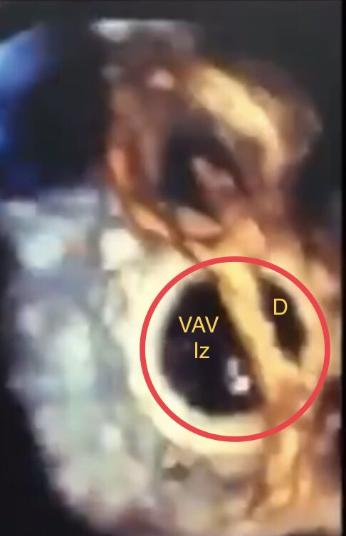cardiopedhnn's tweet photo. @CyntiaMachain @03Nitram @mariovar55 @cardiogax 1-Canal AV o #DSAV con componente IA abierto (CIA I) y componente IV cerrado (no CIV) x inserción de válvulas de puente y tejido accesorio (flecha roja).
2-Anillo AV único (círculo rojo)
3-Válvula AV Iz trivalva con porción Iz de válvulas de puente (1, 2) y válvula mural (3) https://t.co/g39EOKof81