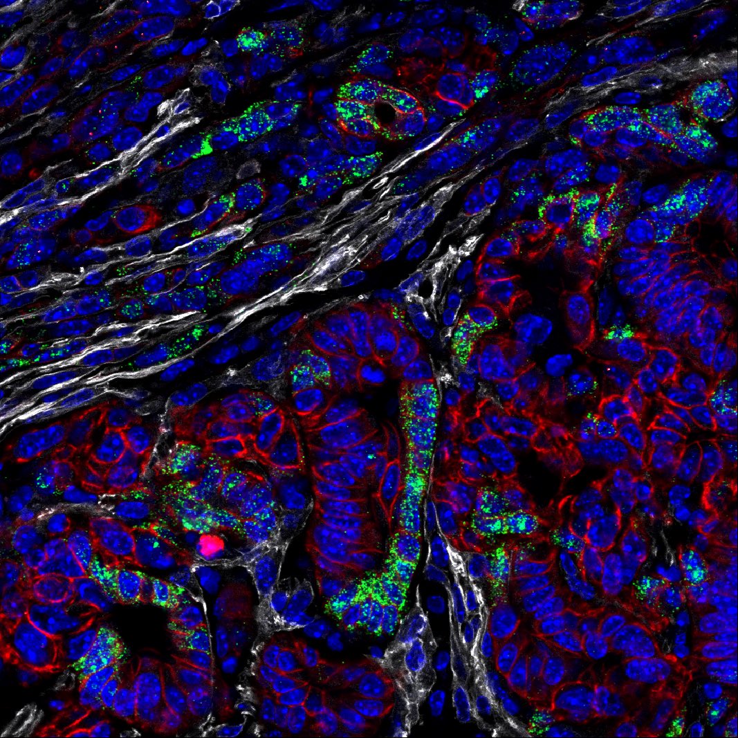 NinaSteele17's tweet photo. Sunday night #RNAScope #Hedgehogsignaling inspiration in murine #PDAC tumor! ๐
โช๏ธpdpn ๐ดecad ๐ISH shh
@ACDbio
Can't wait to start upping my multiplex game soon...๐ https://t.co/zhuugZkoY3