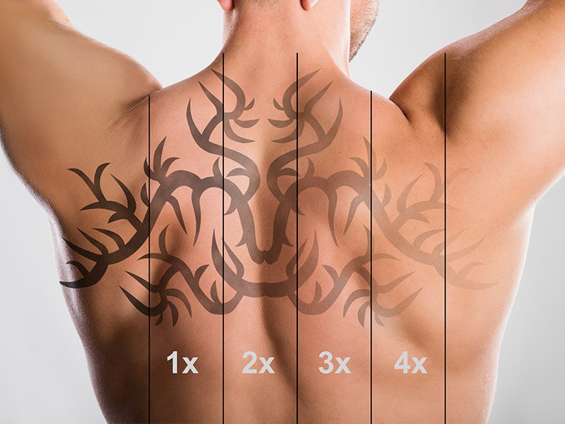 Tattoo Removal Safe